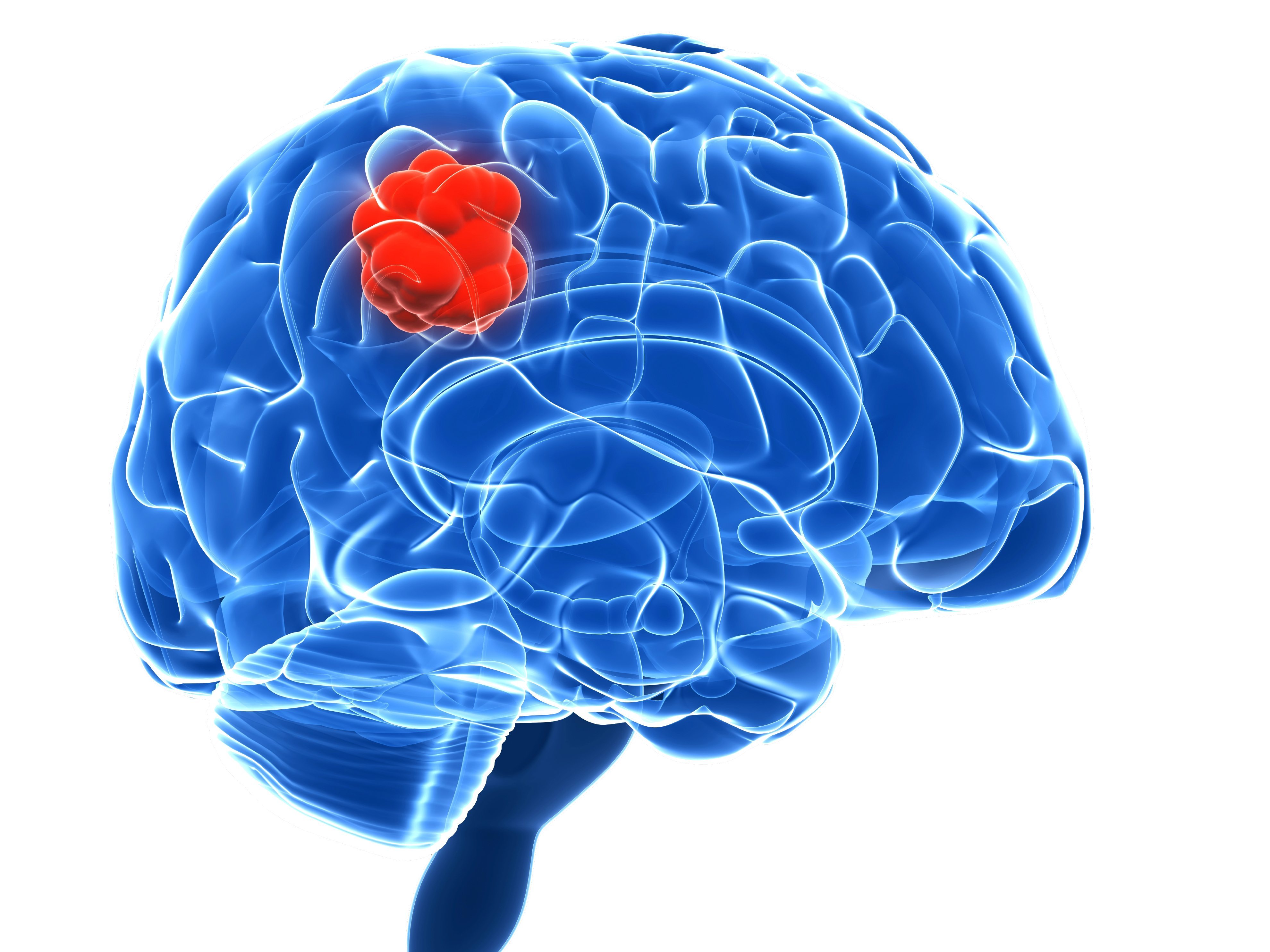 Read more about the article Nova tecnologia permite perceber melhor os tumores cerebrais